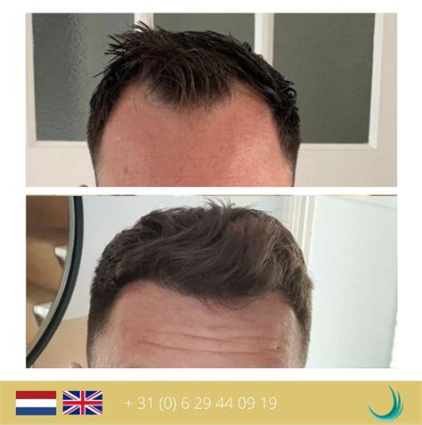 De Genezingstijd Na Een Haartransplantatie Behandeling
