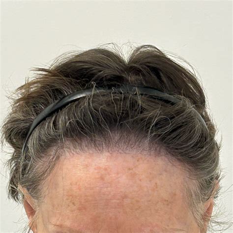 Haartransplantatie En Leeftijdsgebonden Haarverlies