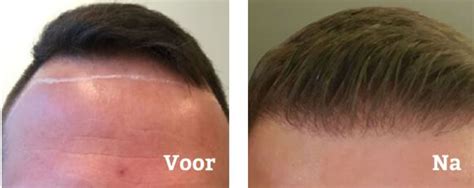 Impact Van Hormonen Op Haartransplantatie Resultaten